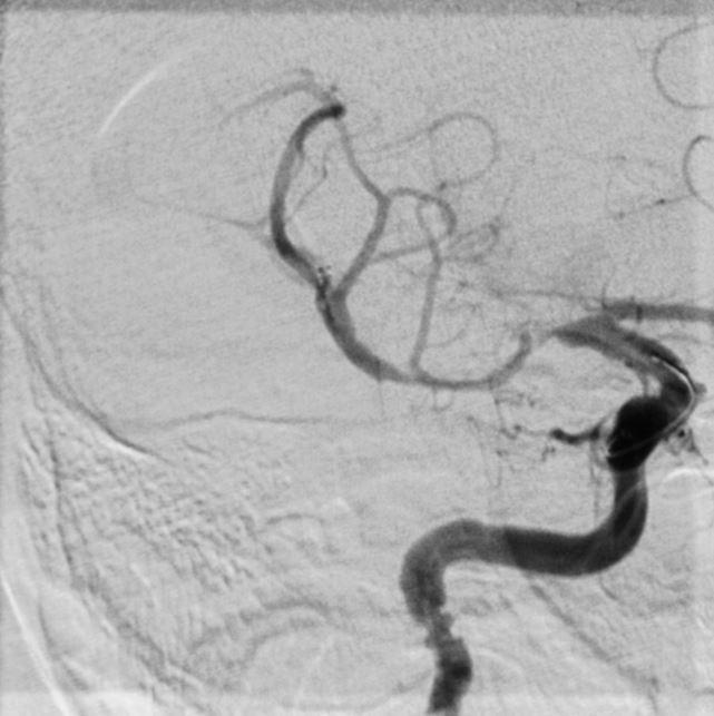 The area of occlusion is accessed very carefully using a very tiny tube (1 mm thick). A retrievable stent, the Solitaire, is deployed and there is instantaneous restoration of blood flow to the brain. The stent is then withdrawn, capturing the clot and opening the vessel.